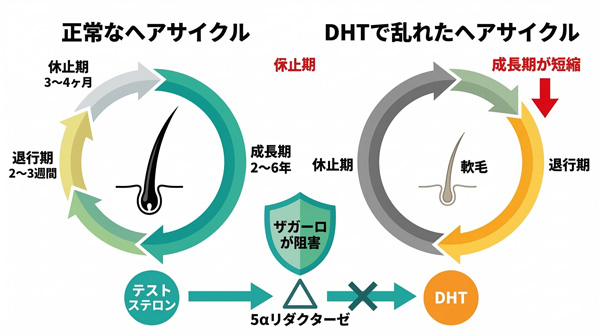 正常なヘアサイクルとDHTで成長期が短縮されたヘアサイクルの比較図。ザガーロが5αリダクターゼを阻害しDHT生成を抑制する仕組み